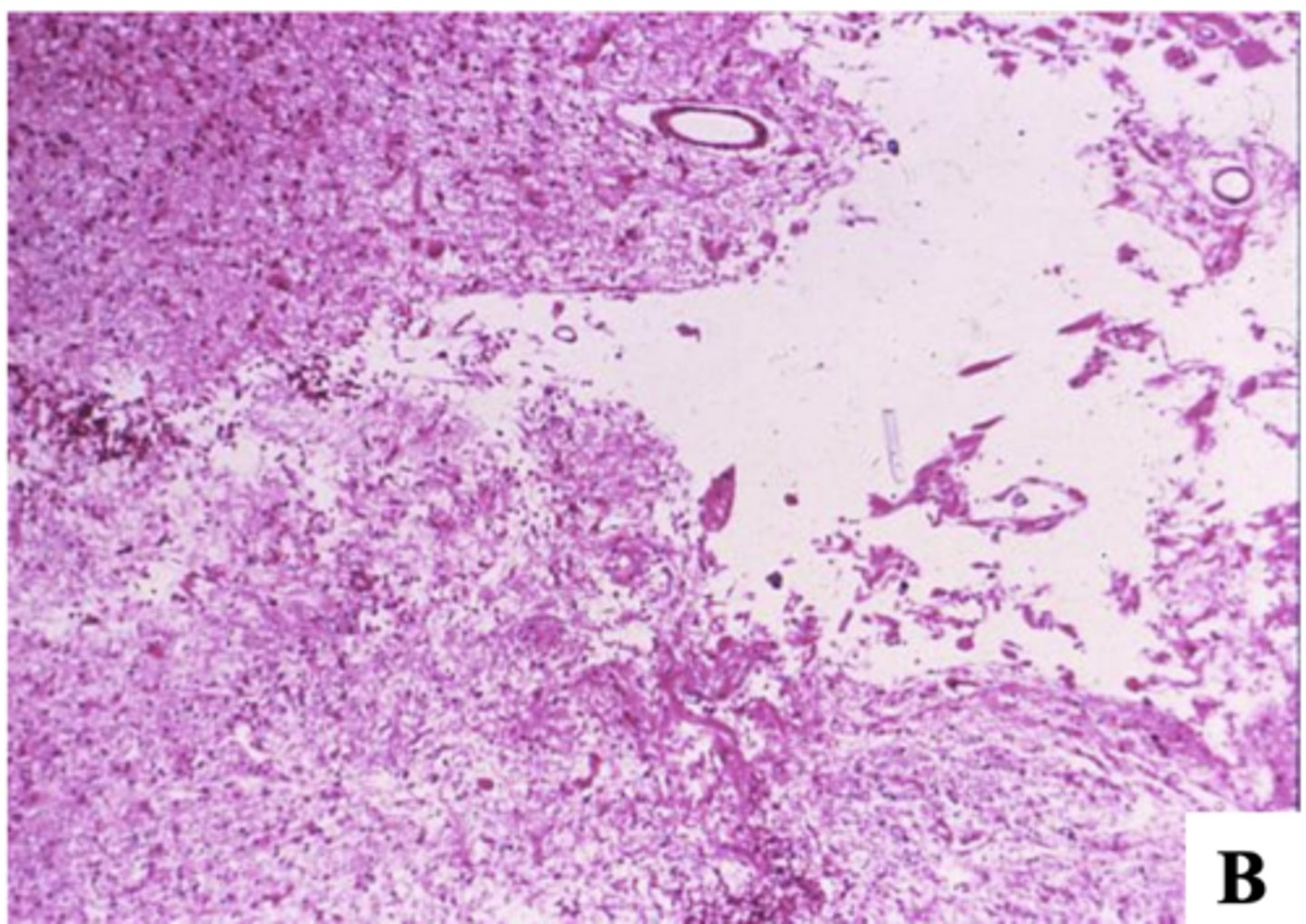 <p>2-3 weeks or months after the stroke:</p><p>-gliosis</p><p>-cystic cavity</p>