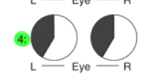 <p>Partial loss of the right temporal retinal field and left nasal retina field</p>