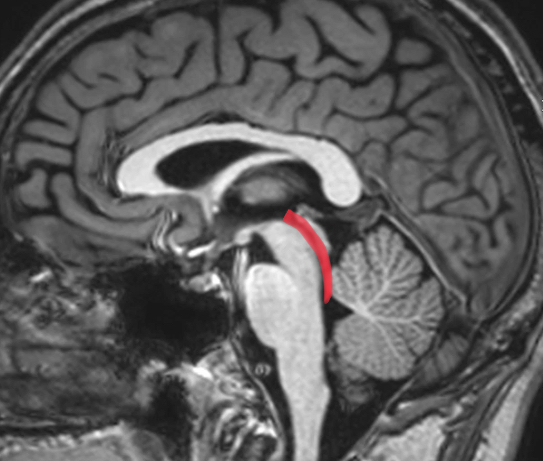 <p>15-18 mm in length, 1-2 mm in diameter</p><p>within posterior midbrain</p><p>anterior to cerebellum</p>