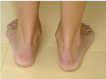 <p>tibialis posterior signs and symptoms</p>