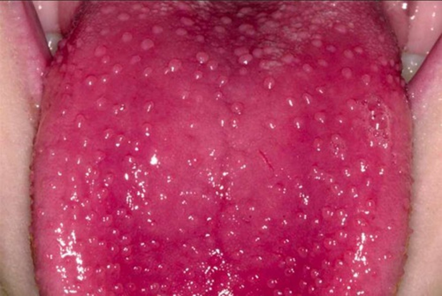 <p>Pharyngitis (strep throat)</p>