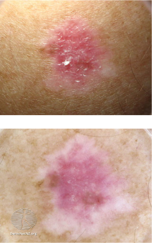 <ul><li><p>melanoma lesion w/ NO pigment</p></li><li><p>may present as pink or red ,accuses/papules/nodules</p></li><li><p>well defined borders</p></li><li><p>often clinically confused w/ benign lesions (hemangioma, pyogenic granuloma, SKs)</p></li></ul><p></p>