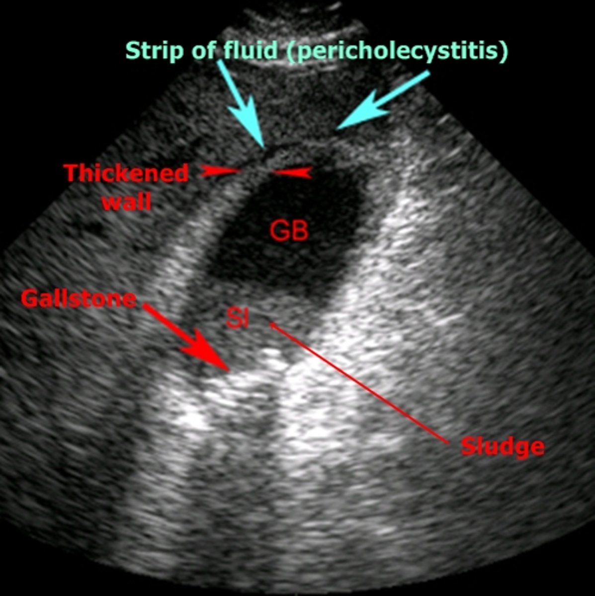 <p>US- used most commonly, not best option</p><p>HIDA scan- useful for obstructed biliary duct, 96% sensitivity 90% specificity</p><p>MRI- 88% sensitivity 89% specificity</p><p>CT- may show perf or gangrene</p>