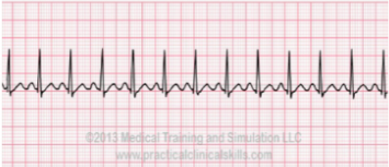<p><u>In Sinus Tachycardia</u></p><ul><li><p>Rate is faster than __ bpm</p></li><li><p>QRS is __, ST is __ and slightly __, T-wave is __</p></li></ul><p></p>
