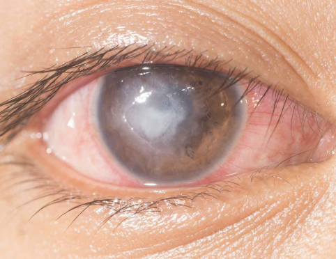 <p>One of the 6 Corneal Abnormalities</p><ul><li><p>An<strong> open sore</strong> on the cornea, often resulting from untreated <strong>keratitis</strong> or <strong>corneal abrasions</strong></p></li><li><p>Can lead to permanent scarring and vision loss if not promptly treated</p></li></ul><p></p>