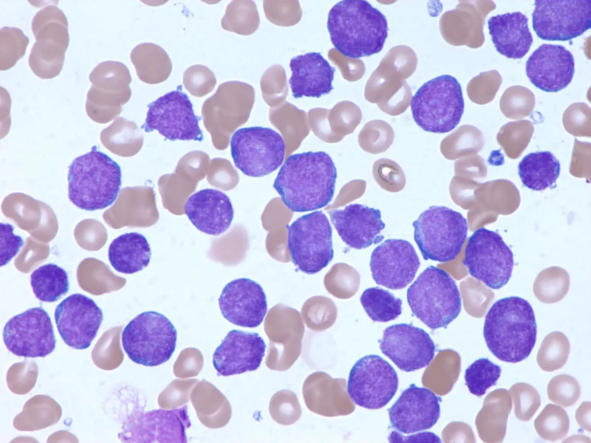 <ul><li><p><strong>clinical features</strong></p><ul><li><p>fever, pallor, fatigue, bleeding, bone and joint pain, hepatosplenomegaly</p></li></ul></li><li><p><strong>lab findings</strong></p><ul><li><p>variable WBC</p></li><li><p>anemia and thrombocytopenia</p></li><li><p>blood and bone marrow show lymphoblasts <u>twice the size</u> of normal small lymphocytes (may or may not have vacuoles)</p></li><li><p><em>picture shows B lymphoblastic leukemia (B-ALL)</em></p></li></ul></li></ul><p></p>