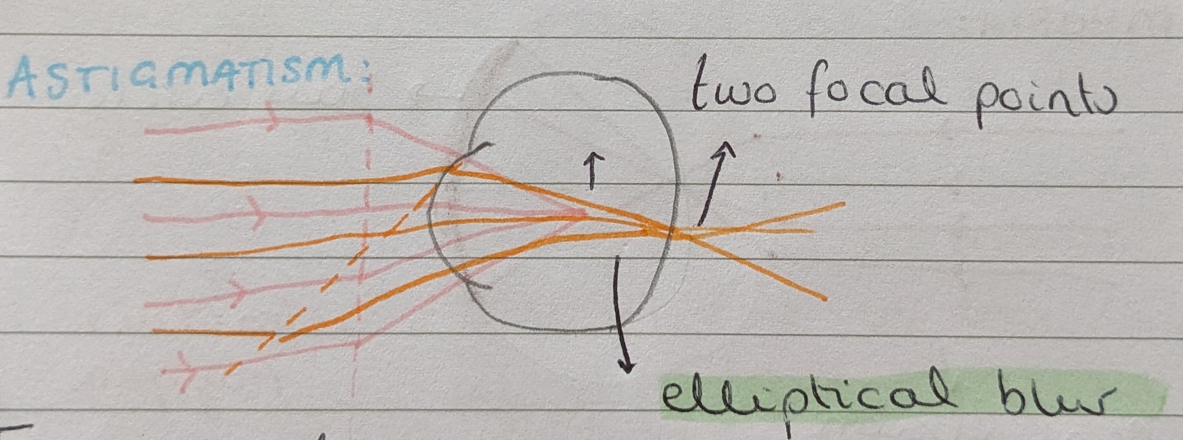<p>Astigmatism is a type of refractive error caused by the cornea and lens having different curvatures in different meridians. This results in the image forming two focal points, creating an elliptical blur on the retina. The patient may complain of a characteristic stretched distortion to their vision, especially when looking at lights. </p><p></p><p>In regular astigmatism, these curvatures are at 90<sup>o</sup> to each other and can be corrected with lenses. </p><p>In irregular astigmatism, the curvatures do not conform to any particular geometry and so cannot be corrected with lenses. This is seen in <strong>keratoconus. </strong></p>