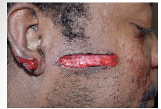 <p>tears with skin tag formation</p>