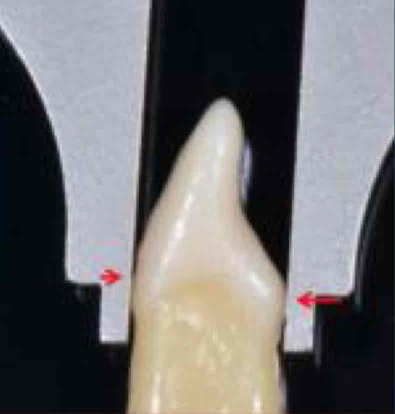 <p>what is the height of contour  for the labial and lingual surface of all anterior teeth?</p><ul><li><p>on the lingual side, the HOC is on the cingulum</p></li></ul>