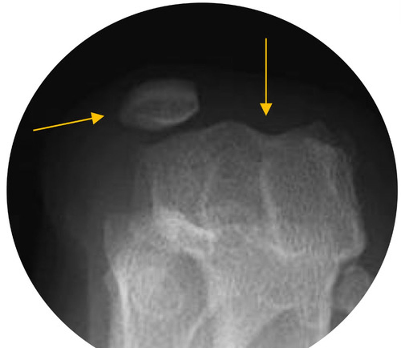 <p>What is the issue shown in the radiograph?</p>