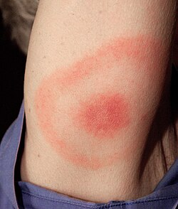 <p>Lyme disease</p>