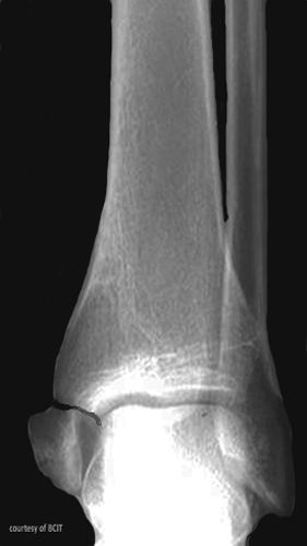<p>Inversion with axial loading.</p>
