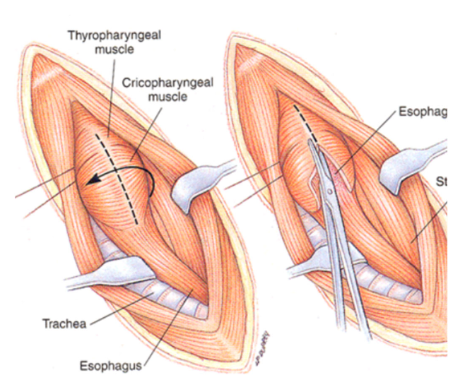 <p>-surgical myotomy of cricopharyngeal muscle (unilateral); less successful with asynchrony</p><p>-injection of botulinum toxin into muscle (temporary for 3-4 months), if positive response, may respond favorably to surgery&nbsp;</p><p>-gastrostomy tube</p>