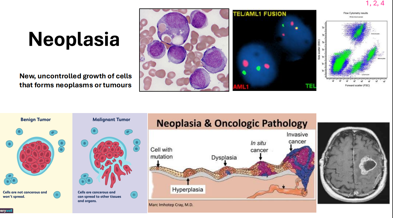 <p>- new, uncontrolled growth of cells that forms neoplasms or tumours</p><p>- e.g skin cancers</p>