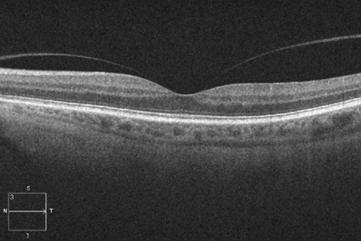<p>all retinal layers intact = no distortion = asymptomatic</p>