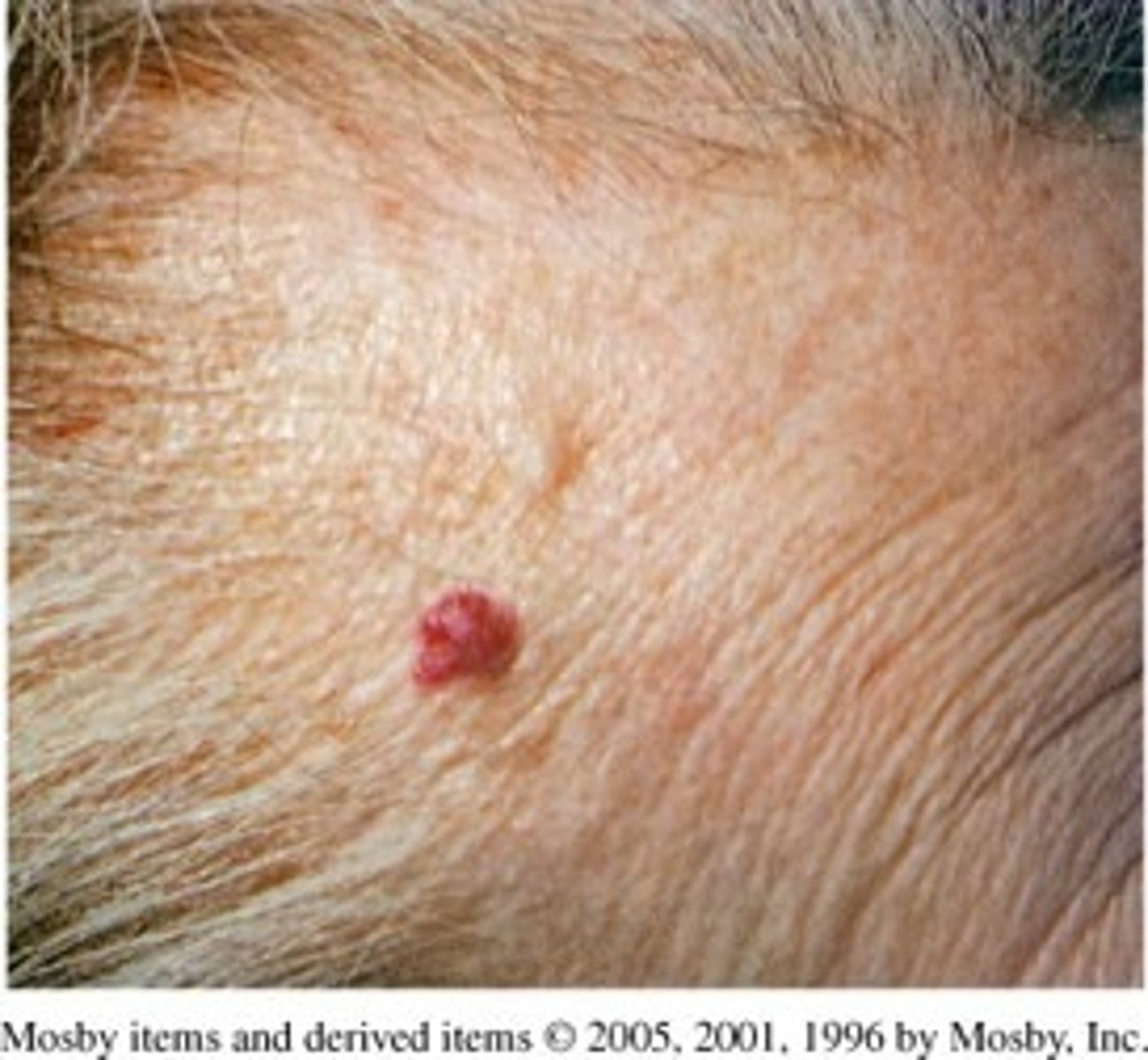 <p>-Solid (firm), elevated lesion with no visible fluid</p><p>-1/2 to 1 cm</p><p>Examples:</p><p>-Elevated mole</p><p>-Skin tag</p><p>-Warts</p><p>-Cherry angioma</p>