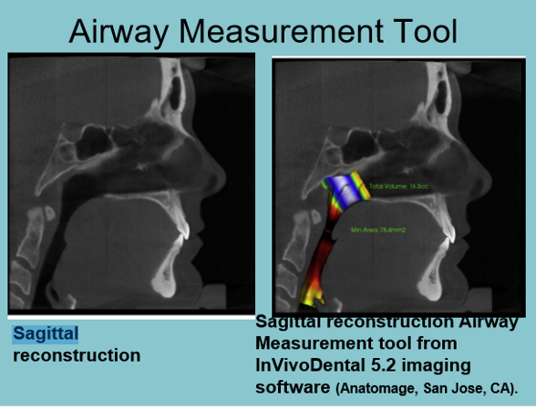 <p>How is a sagittal CBCT reconstruction viewed?</p>