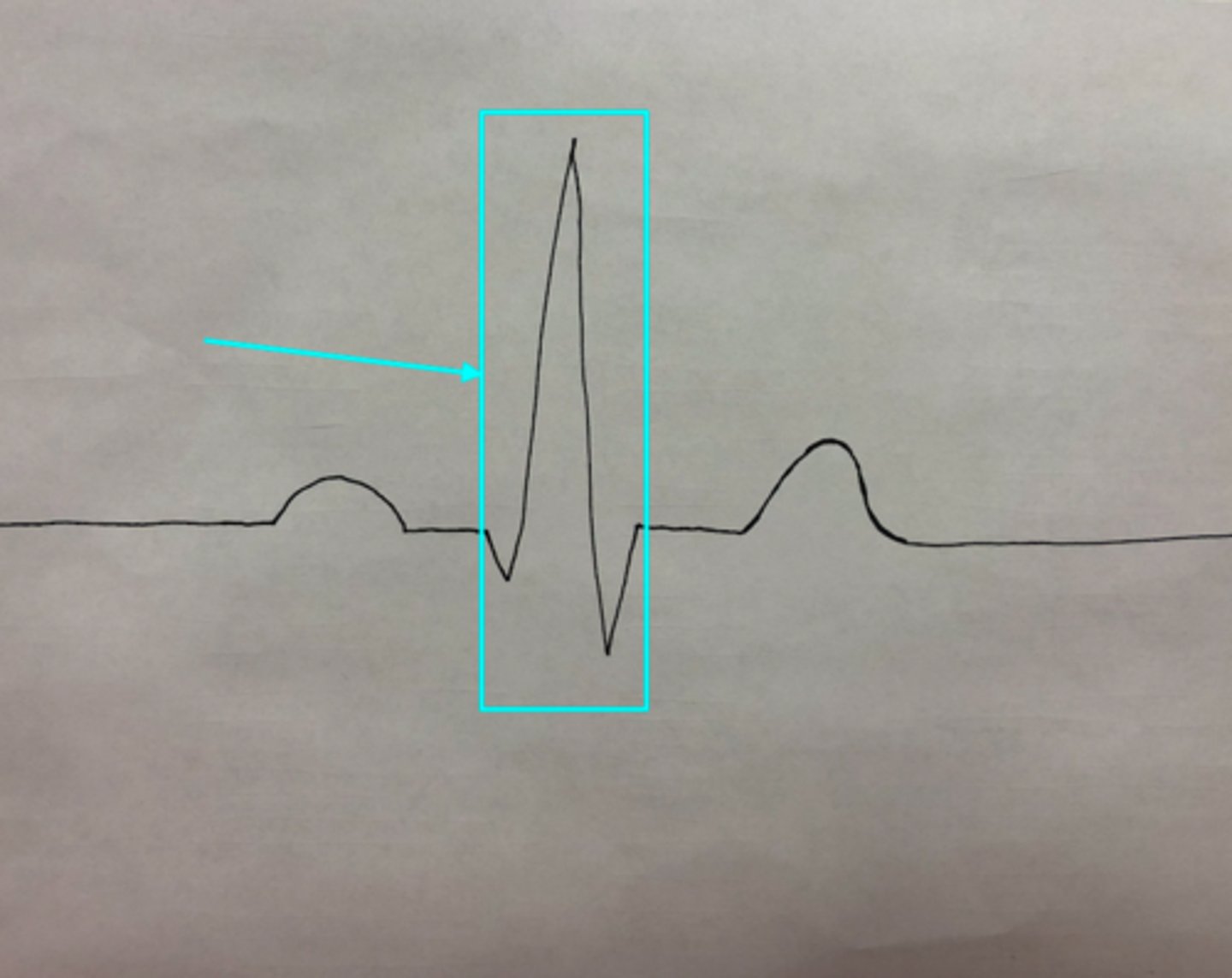 <p>What feature of an ECG is the blue arrow pointing at?</p>