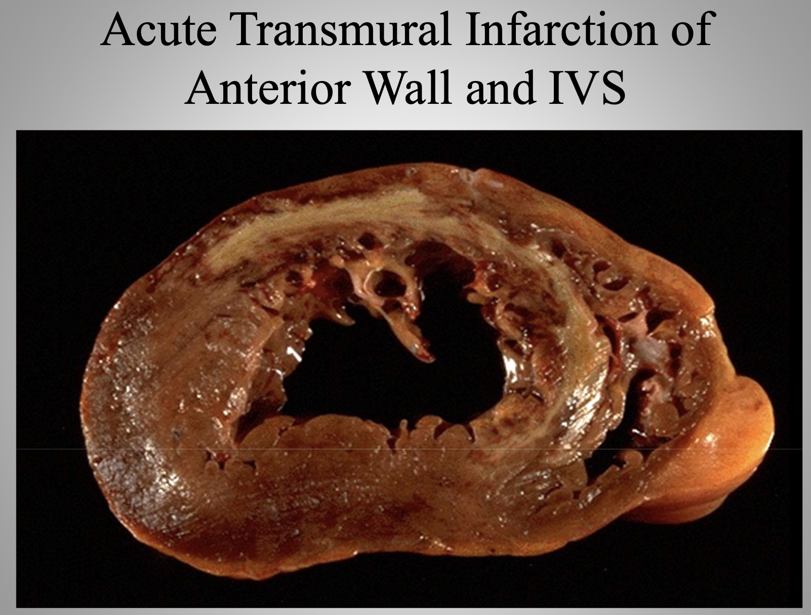 <p>Acute Disease</p>