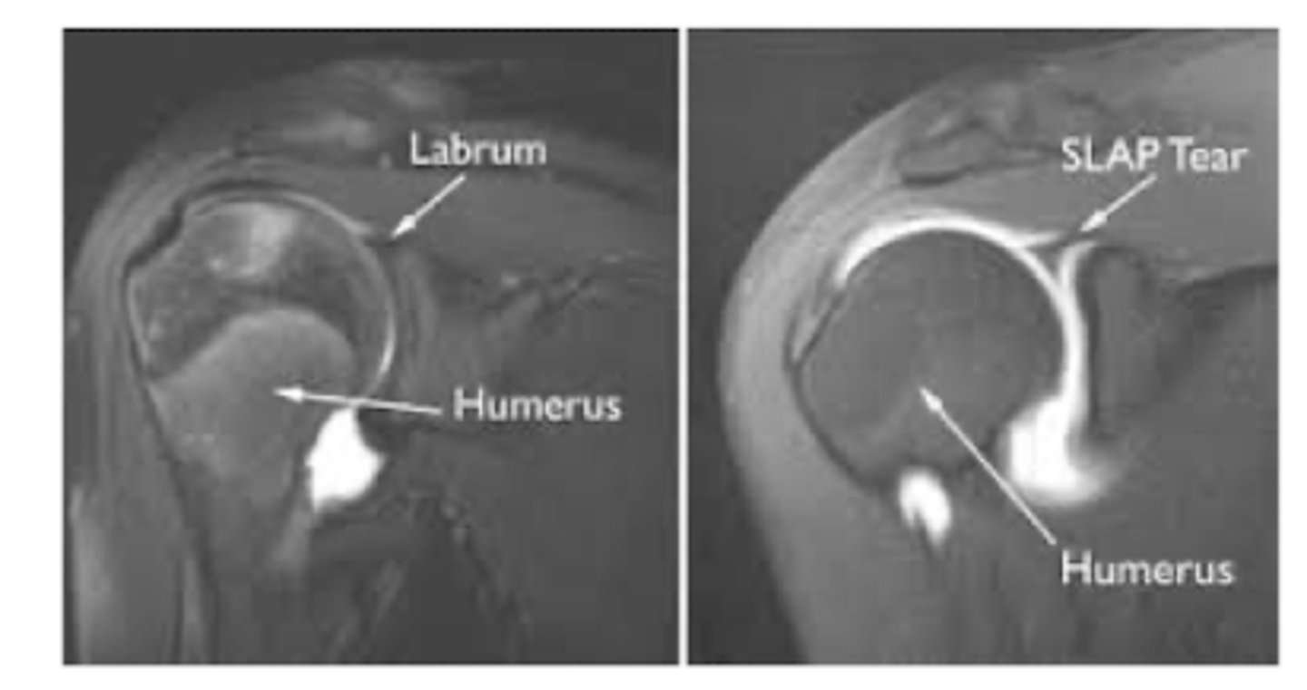 <p>MRA (arthrogram)</p>