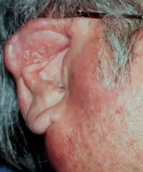 <p>What are some clinical features of mucoepidermoid carcinoma?</p>