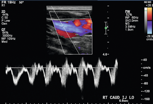 <p><span>Select the best description for this IJ waveform.&nbsp;</span></p>