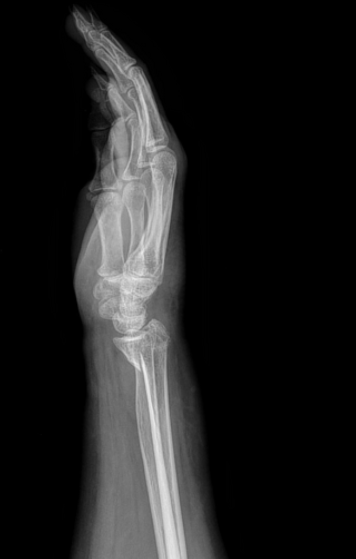 <p>A transverse distal radius fracture VOLARLY displaces and extra-articular</p>