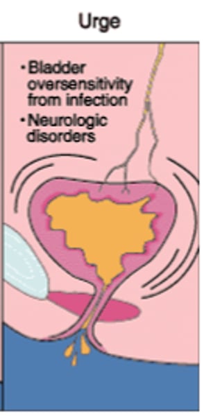 <p>Overactive bladder- the loss of urine as soon as you feel the urge to go to the bathroom<br>- due to involuntary bladder contraction, common in UTIs</p>