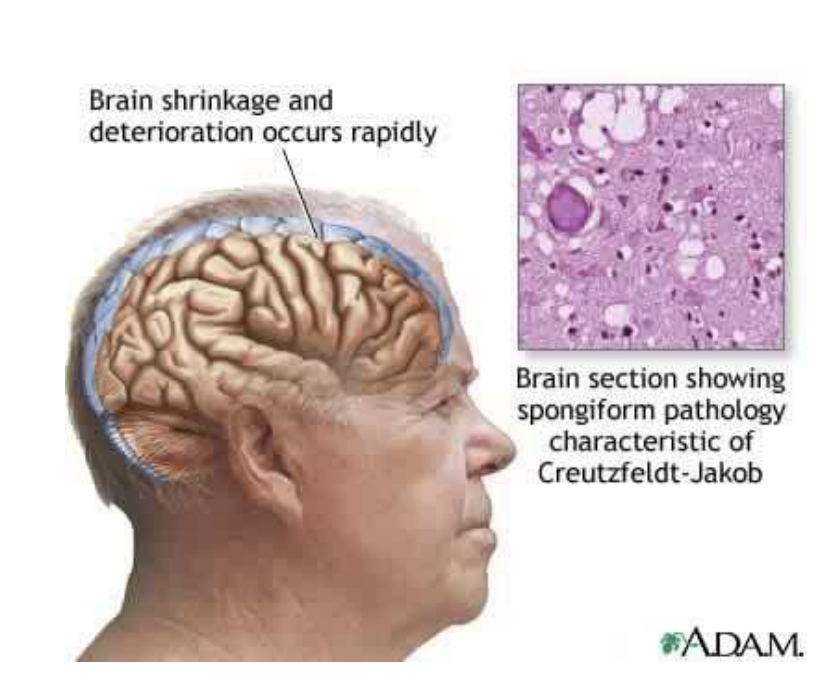 <p>Enumerate 7 symptoms/manifestations of Creutzfeldt-Jakob Disease (CJD)</p>