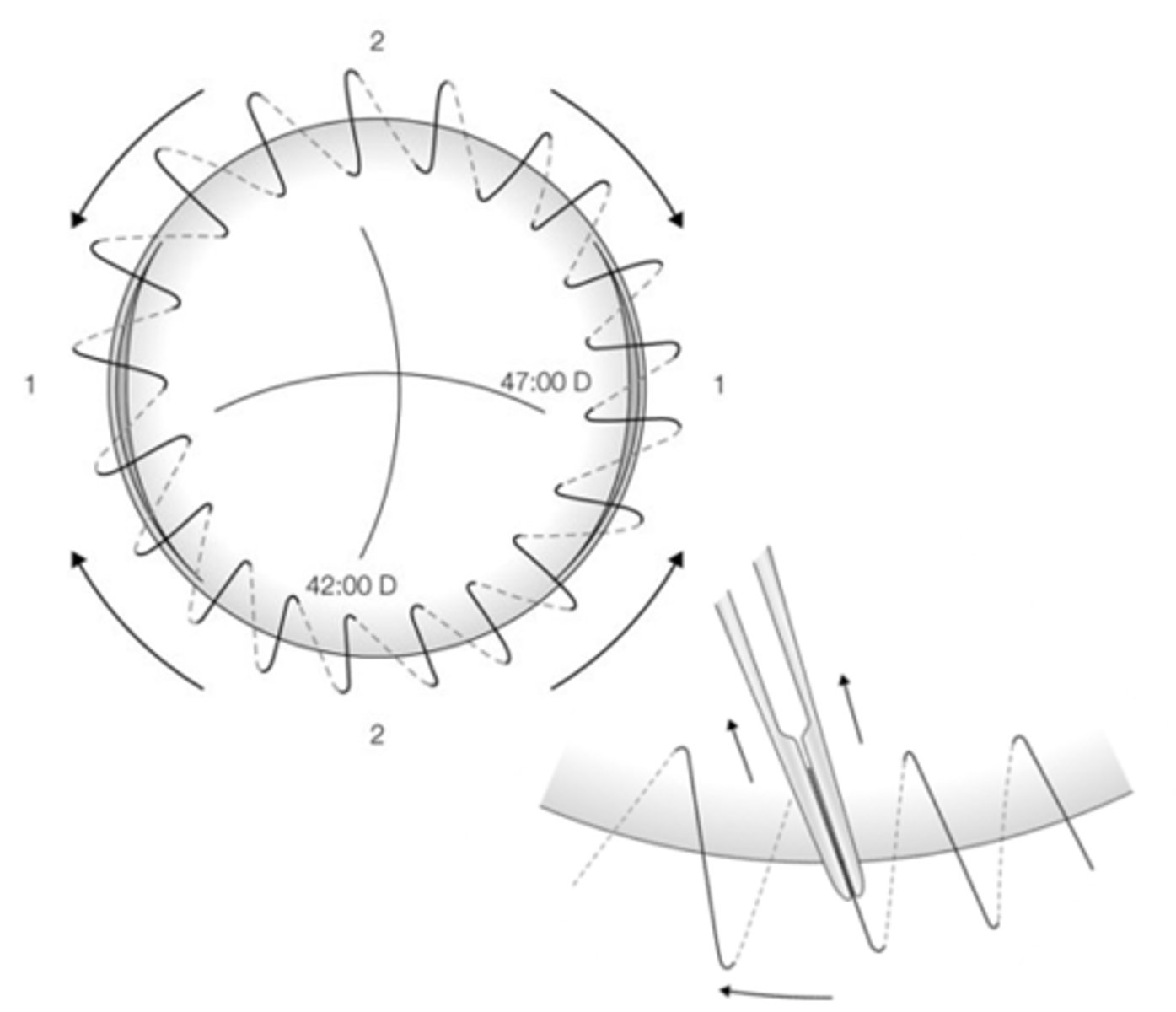 <p>How can we manage/tweak astigmatism after PKP with continuous sutures (less common)?</p>