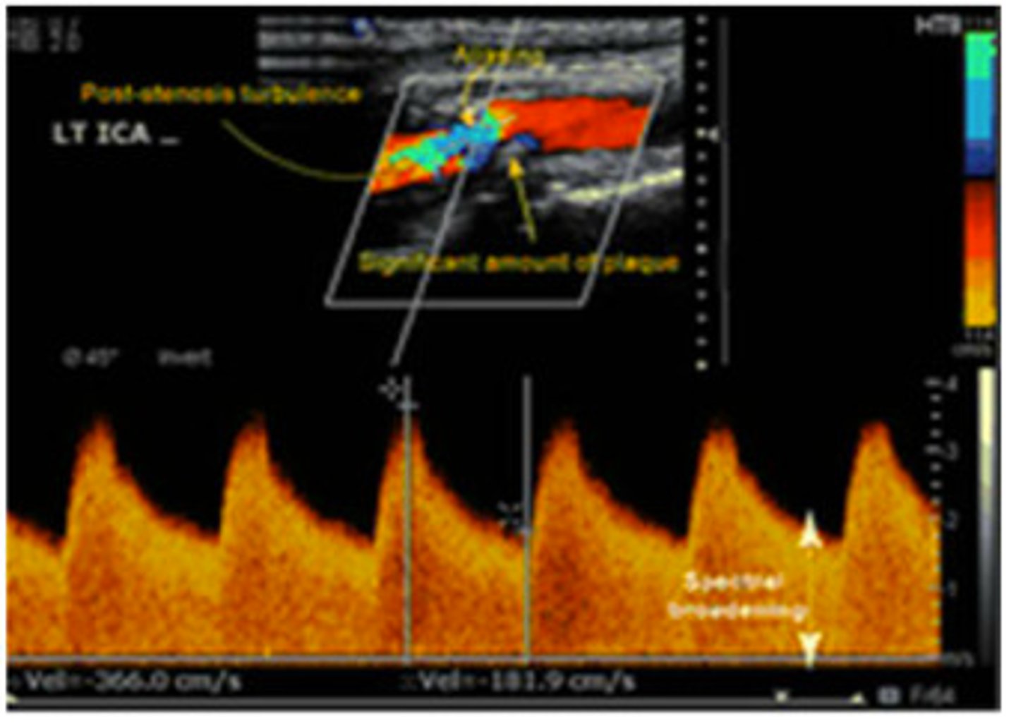 <p>significant stenosis</p>