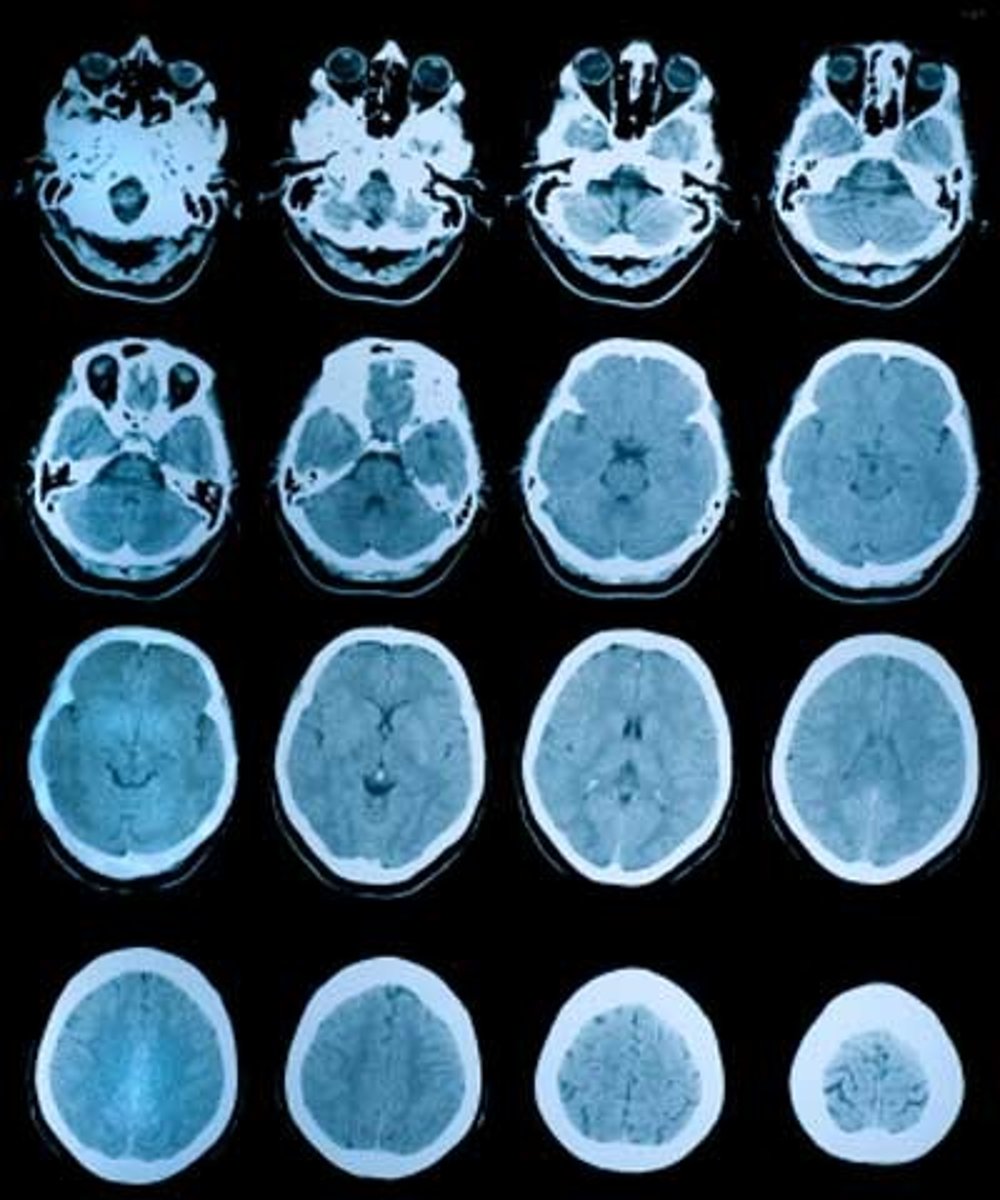 <p>-lots cross-section x-rays taken<br>-all images put together to build detailed picture<br>Advantages:<br>-Useful for revealing abnormal structures in the brain (ie tumors)<br>-Quality of images better than x-rays<br>Disadvantages:<br>-more radiation than x-rays so can't be used often<br>-only provide structural information</p>