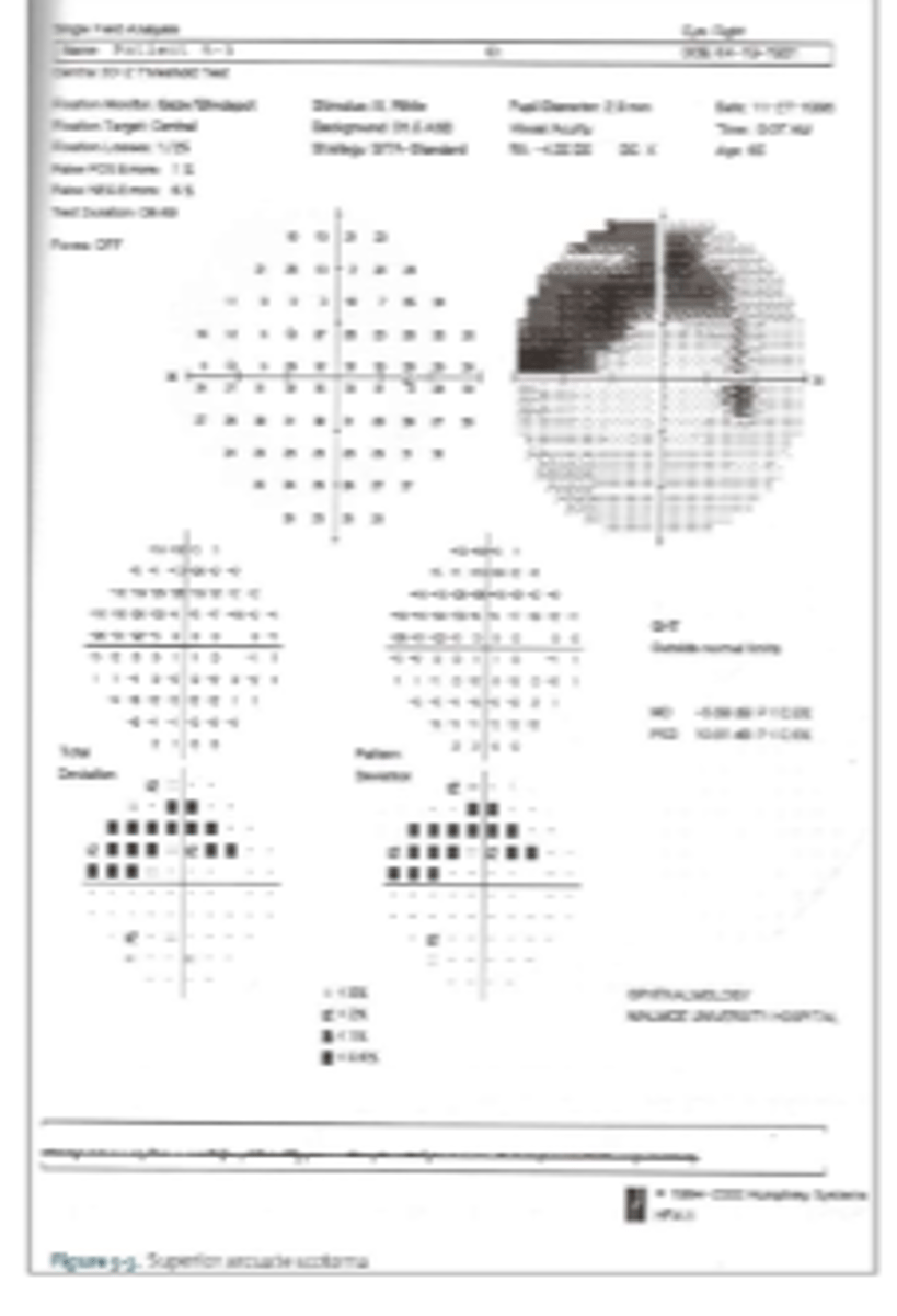 <p>more GCs along NFL bundle dies, getting closer and closer to disc --> eventual arcuate scotoma</p>