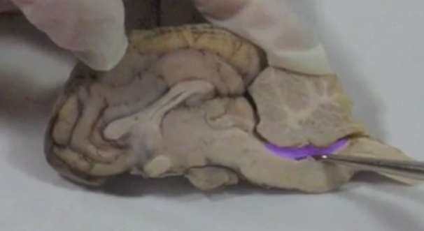 <p>Fourth ventricle </p>