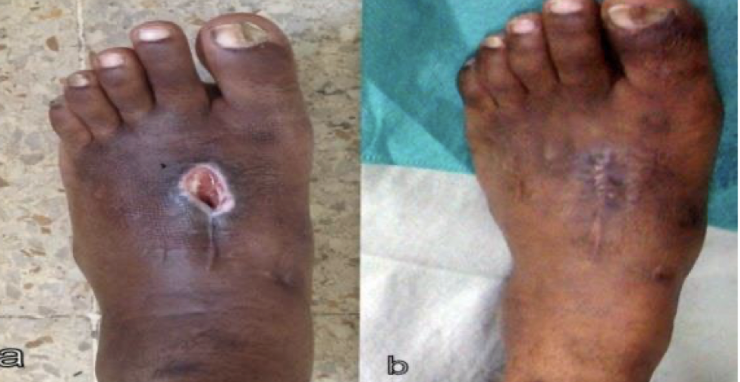 <p>large wound with inflammation/infection/ischemia and distant borders that results in extensive scarring and wound contraction (repair)</p>