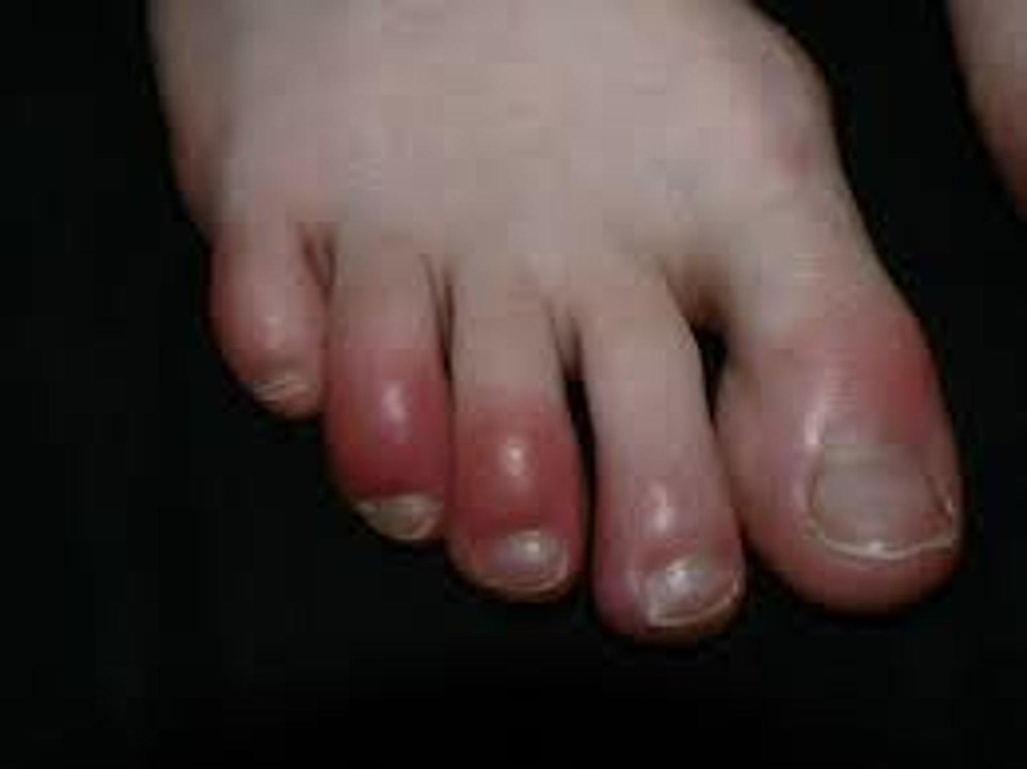 <p>painful inflammatory lesions typically affecting ears, hands, and feet from chronic exposure to intermittent damp conditions</p><p>localized edema, erythema and cyanosis appearing up to 12 hours after exposure + itching and burning paresthesia</p>
