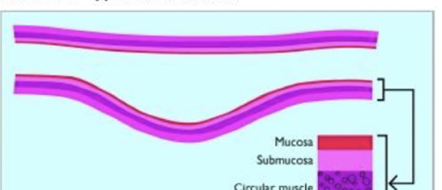 <p>ID type of diverticulum</p>