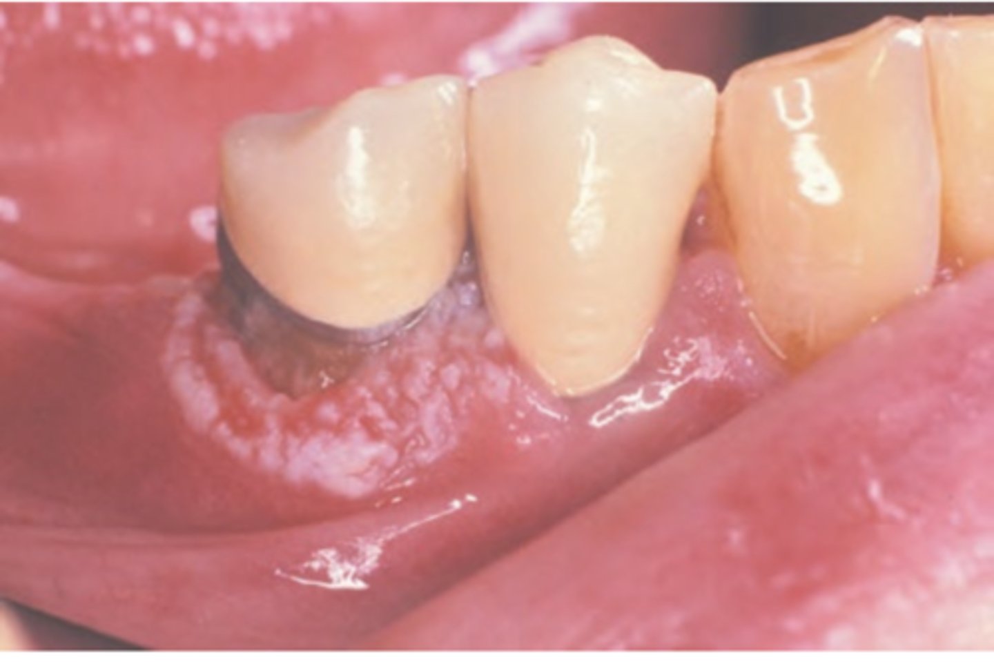 <p>Hint: mimics common, benign inflammatory and reactive lesions (pyogenic granuloma)</p>