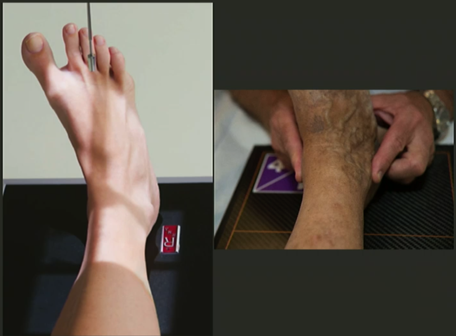 <ul><li><p>Patient sitting or lying on table with leg extended out front.</p></li><li><p>From AP position, rotate internally around 10-15 degrees AT THE FEMUR so malleoli are equidistant from IR.</p></li><li><p>CR perp to IR, at level of malleoli and between malleoli.</p></li><li><p>Collimate for skin edges, include distal 1/3 of tib+fib.</p></li></ul><p></p>