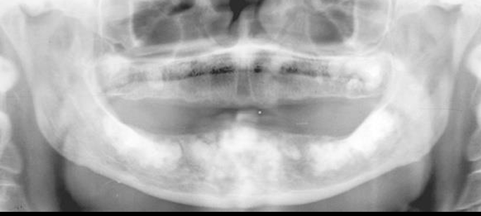<p>-disordered cementum and/or bone production</p><p>-30+ year old female »male, incidental radiographic finding</p><p>-tooth-bearing sites at the periapical region of vital teeth</p><p>-types: periapical (African > Asian, anterior mandibular incisors), focal cemento-osseous dysplasia (Caucasian > African, posterior mandible), florid cemento-osseous dysplasia (African > Asian, multiple jaw quadrants)</p><p>-typical behavior: fibrous CT replaces normal bone and gradually matures by producing dysplastic cementum and/or bone, final stage is sclerotic masses of mineralized product with minimal blood supply and fibrous CT</p><p>-multiple, well-defined radiopacities at apical 1/3 with radiolucent rim</p><p>-do not touch!</p>
