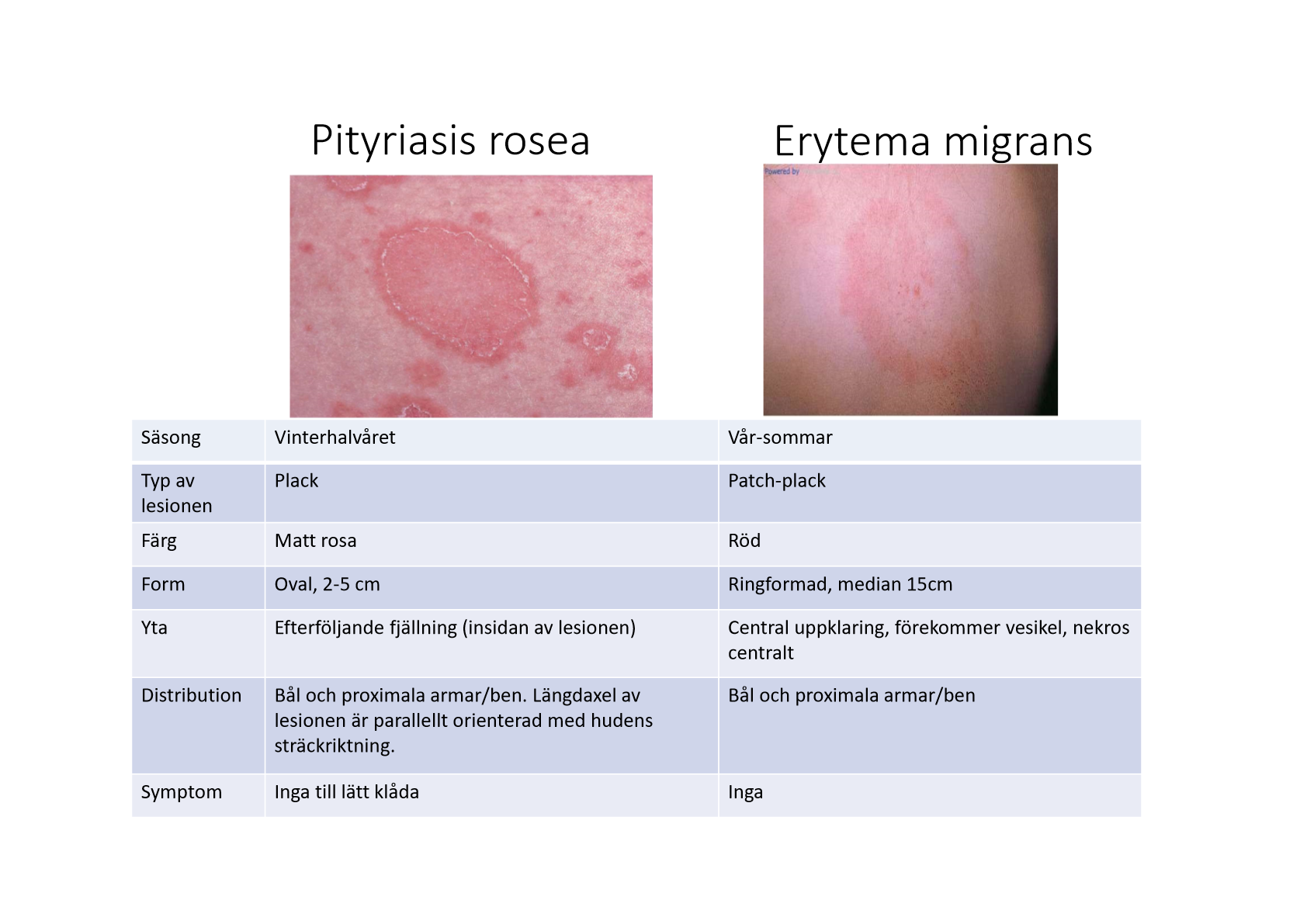 <p>Annan diffdiagnos till erytema migrans.</p><ul><li><p>Börjar med en primär medaljong, en enda fläck som är rodnad. </p></li><li><p>Efterföljande fjällning på insidan av lesionen.</p></li><li><p>Bål och proximala armar/ben. </p></li><li><p>Vinterhalvåret.</p></li><li><p>Oval: 2-5cm.</p></li><li><p>Ingen till lätt klåda.</p></li><li><p>En reaktion i huden p.g.a. virusinfektion. </p></li></ul><p></p>