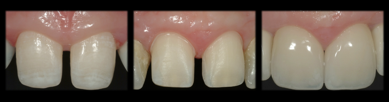 <p>Define Partial-Coverage Restoration</p>