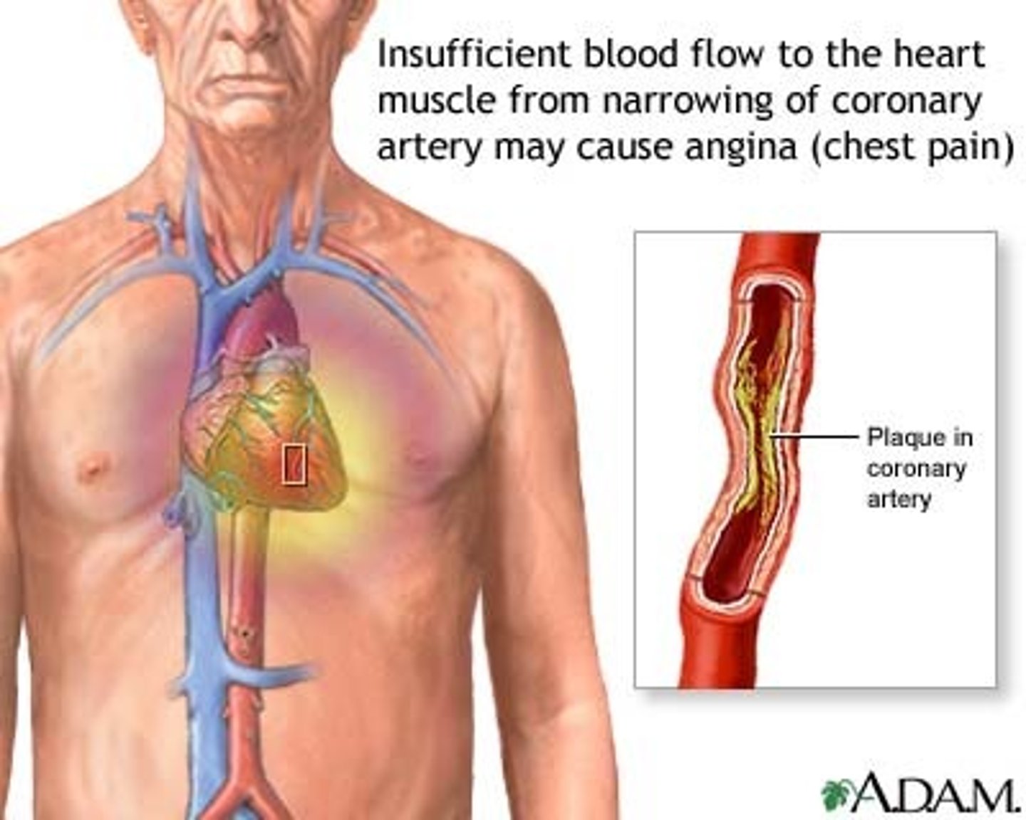 <p>Chest pain due to reduced blood flow to the heart</p>