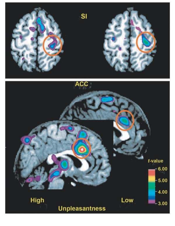 <ul><li><p>Hypnosis: Experiment with lukewarm and hot water: water was actually lukewarm, but hypnosis made them think it was hot water → painful response</p></li><li><p>Anterior cingulate cortex responded differentially to two hypnotic suggestions, by increasing or decreasing its activity</p></li><li><p>Emotional response associated with prefrontal cortex</p></li></ul><p></p>