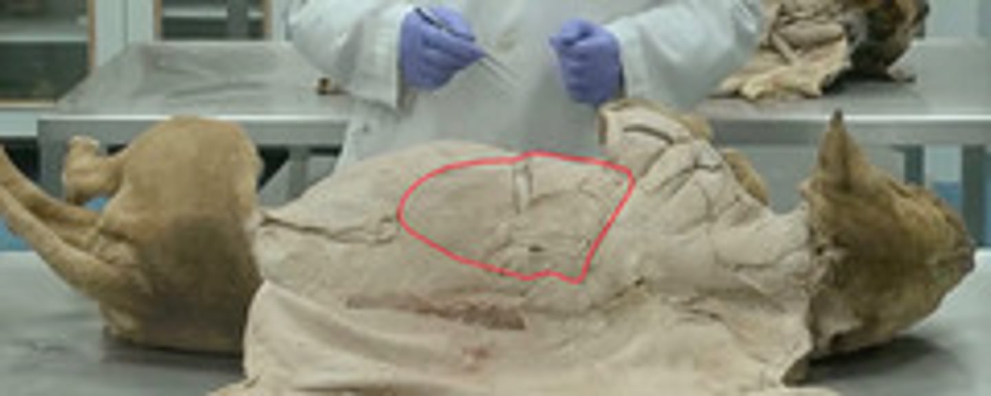 <p>Origen: fascia toracolumbar y últimas costillas</p><p>Inserción: Tuberosidad redondo mayor, tubérculo menor y cara md humero</p><p>Función: principal retroversor del húmero (o flexor del hombro) y rotador externo del hombro. Lateralizador y propulsor del tronco.</p><p>Inervación: n. toracodorsal.</p><p>Fibras cr-vt. Triangular. Ocupa mitad del tórax. Superficial.</p>