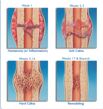 <p>same way when bone is growing</p><p>callus is formed at the site of the break, which forms a new true bone as strong (or even stronger) than the one before it</p>