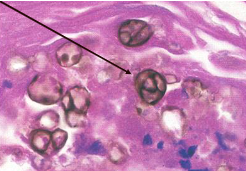 <p>diagnosis of chromoblastomycosis </p>