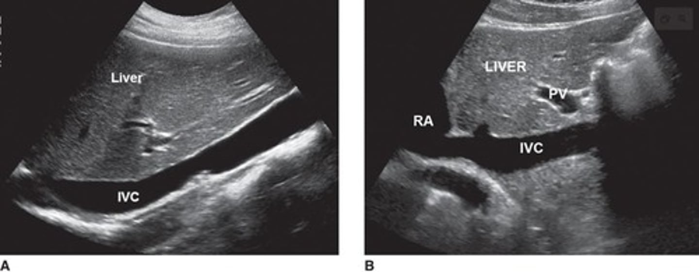 <p>The IVC returns deoxygenated blood to the right atrium of the heart, formed by the common iliac veins.</p>