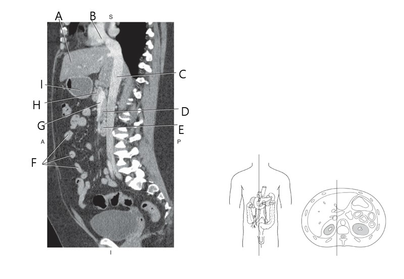 <p>Which arrow is pointing on pancreas uncinate process?</p>