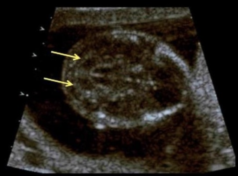 <p>the cerebellum shows what sono sign</p><p>a) fruit salad</p><p>b) banana sign</p><p>c) lemon sign</p><p>d) string of pearls sign</p>